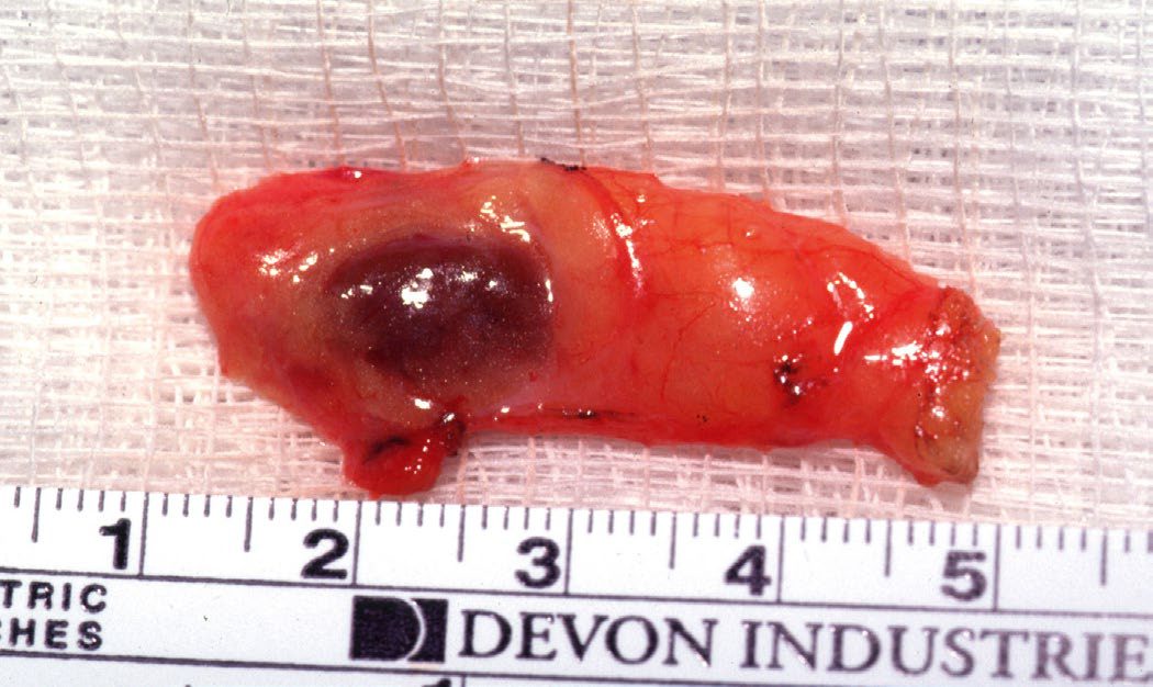 Ectopic intrathymic parathyroid adenoma in the resected specimen