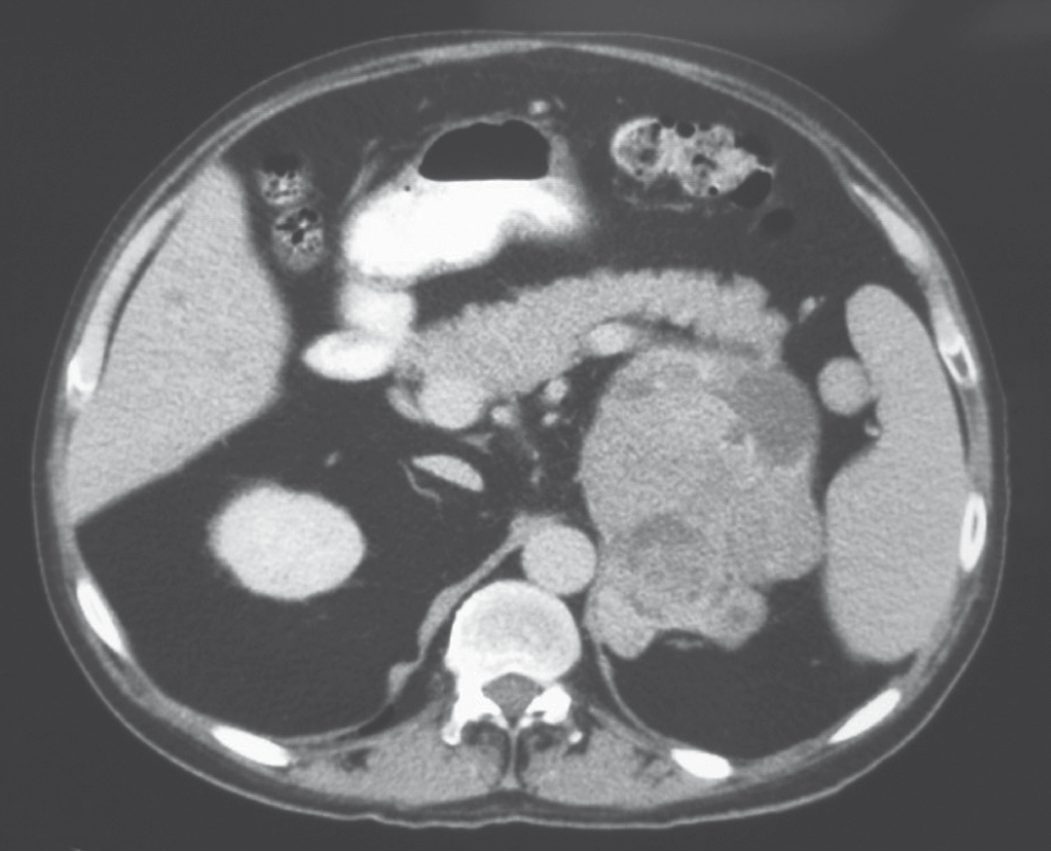 Computed tomography demonstrating a 10-cm left adrenocortical carcinoma with an area of central necrosis
