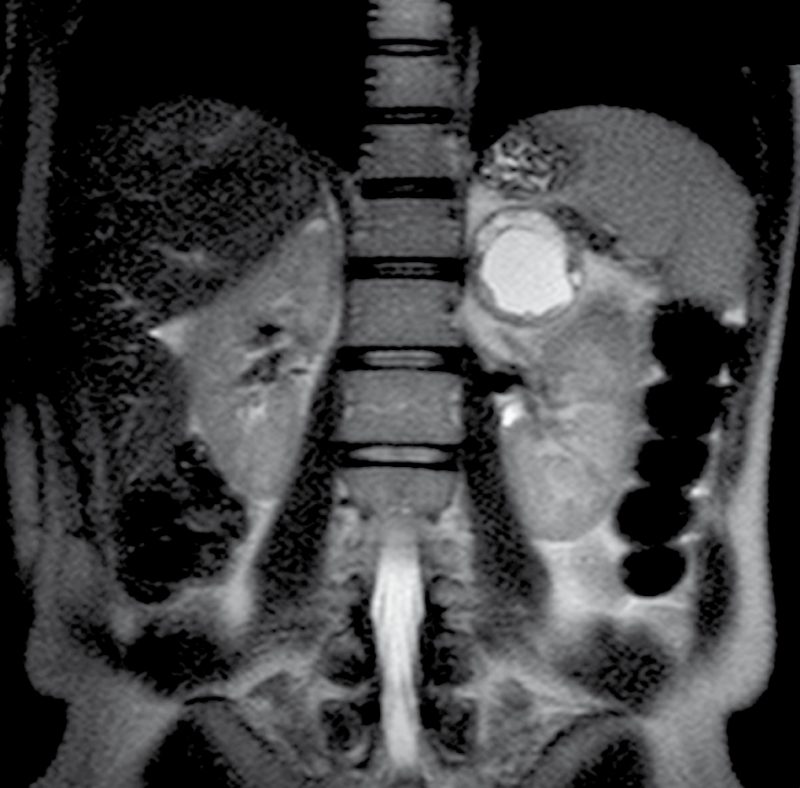 Phaeochromocytoma on contrast-enhanced computed tomography in the venous phase
