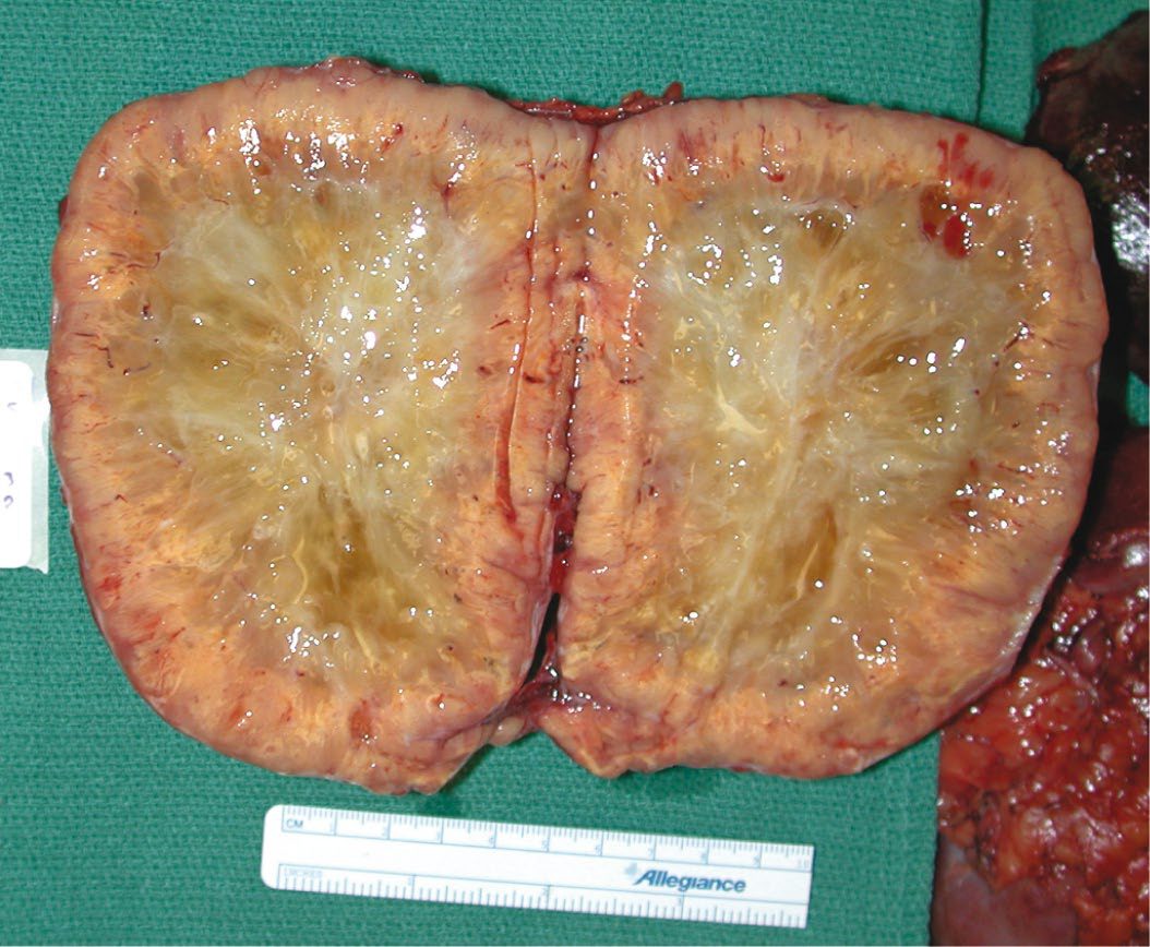 Gross appearance of a phaeochromocytoma at open resection of a left para-aortic extra-adrenal tumour