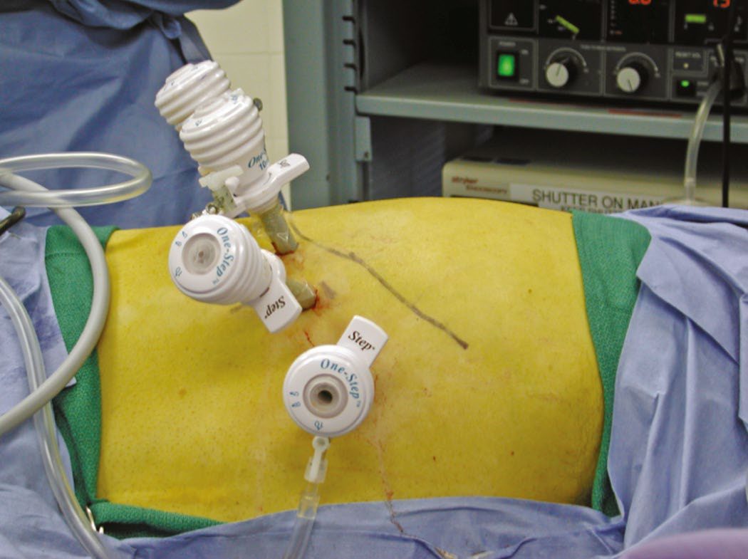 Port placement for right laparoscopic adrenalectomy: patient right-side up, ports placed about 2 cm below the marked costal margin