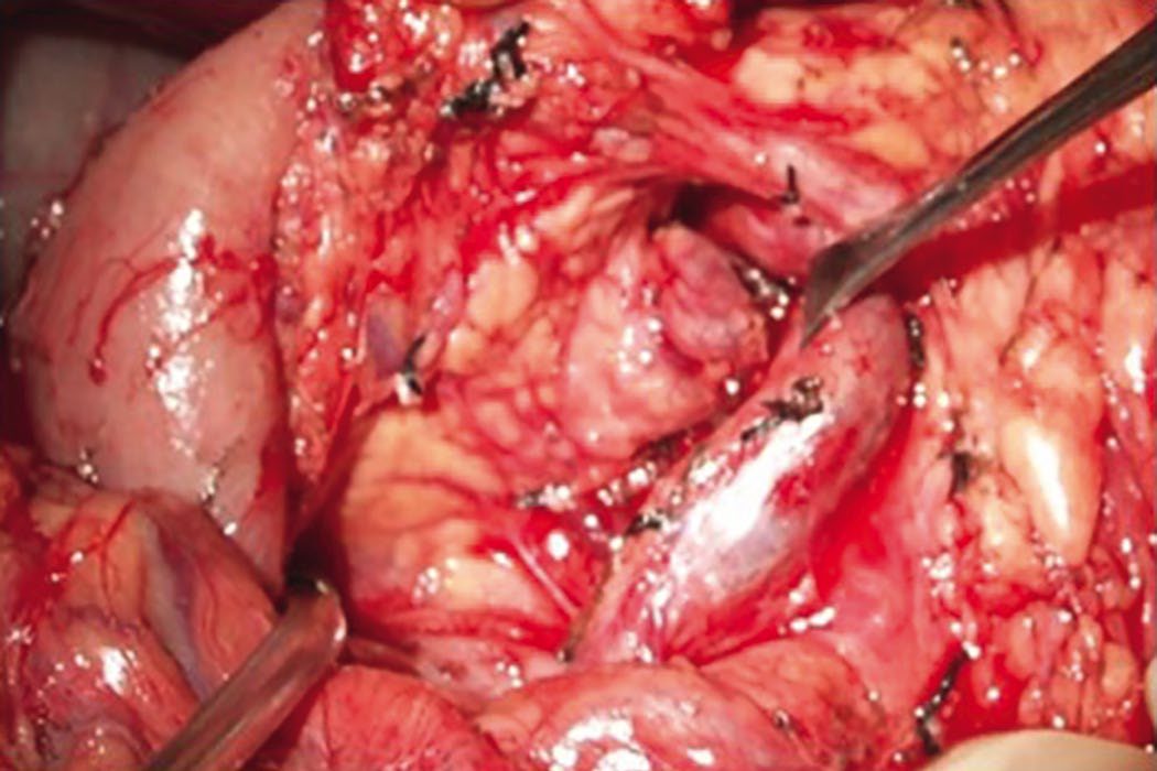 Enucleation of an insulinoma from the uncinate region of the pancreas, with the superior mesenteric vessels in view