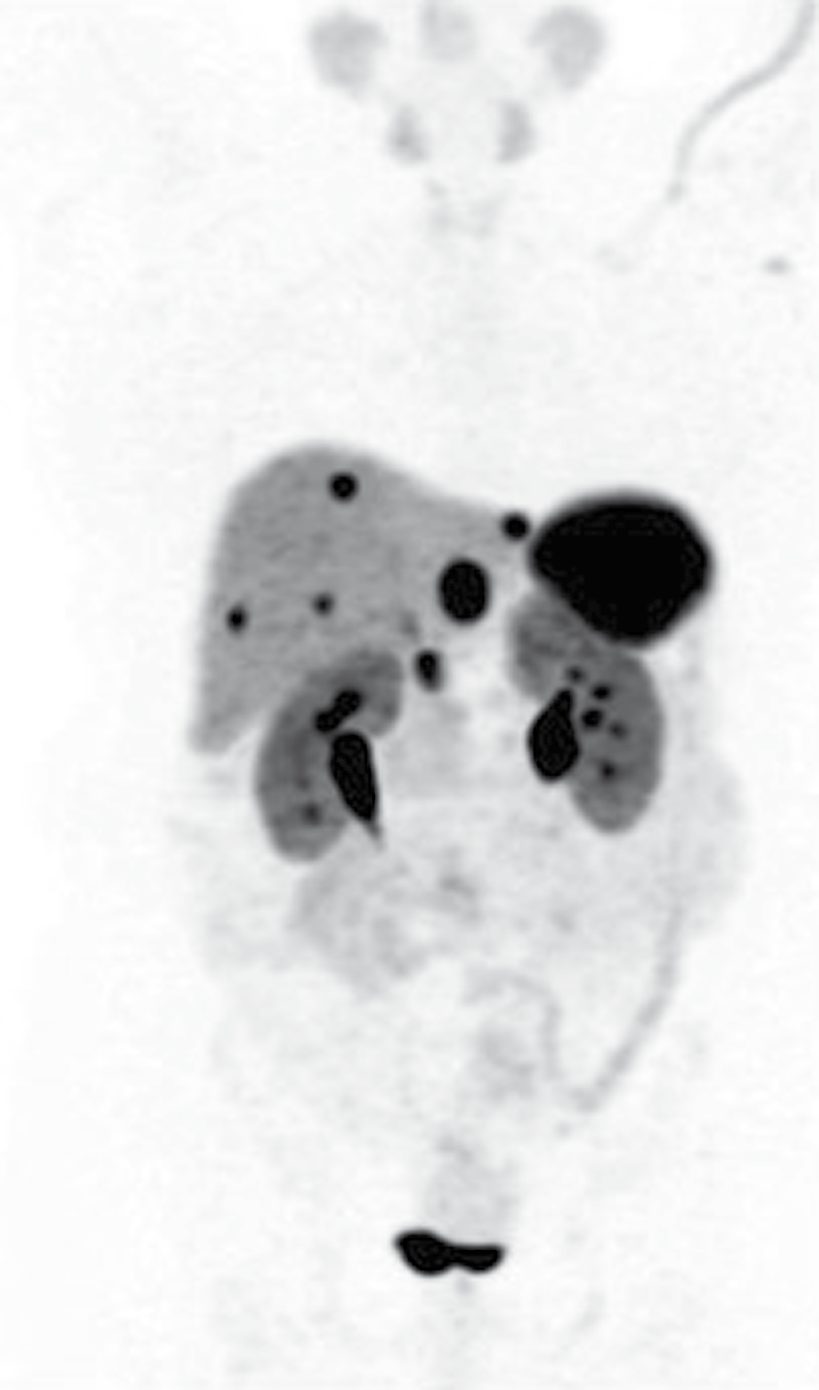 PET-DOTATATE scan in a patient with hypergastrinaemia