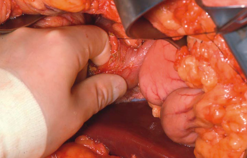 Gastrinoma, intraoperative findings: duodenotomy with palpation of the duodenal wall to locate the tumour