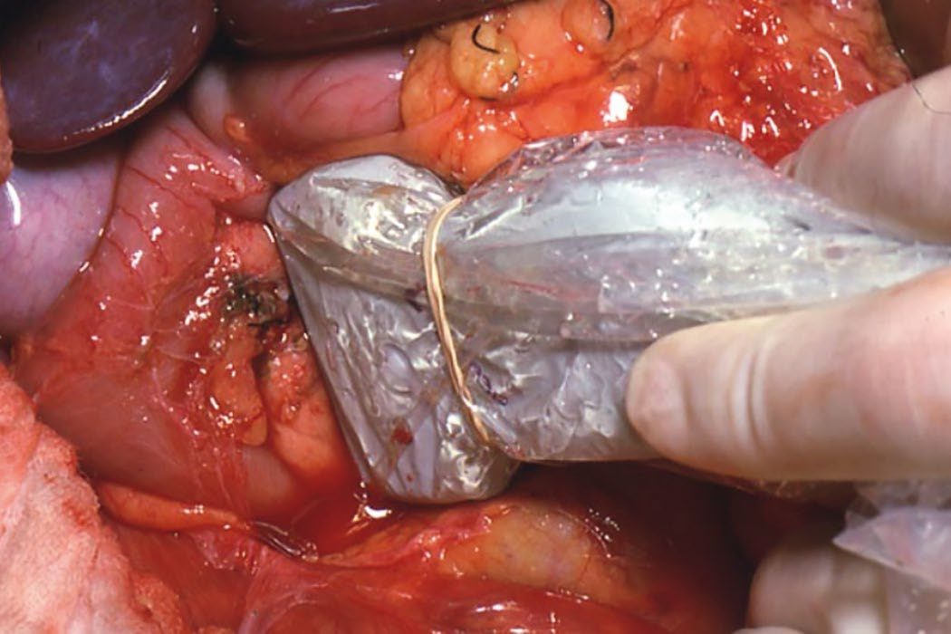Intraoperative ultrasound used to identify an insulinoma and define its relationship to the vessels and pancreatic duct