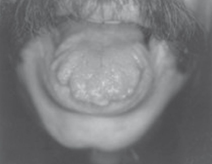Mucosal neuromas of the tongue and lips found in multiple endocrine neoplasia type 2B