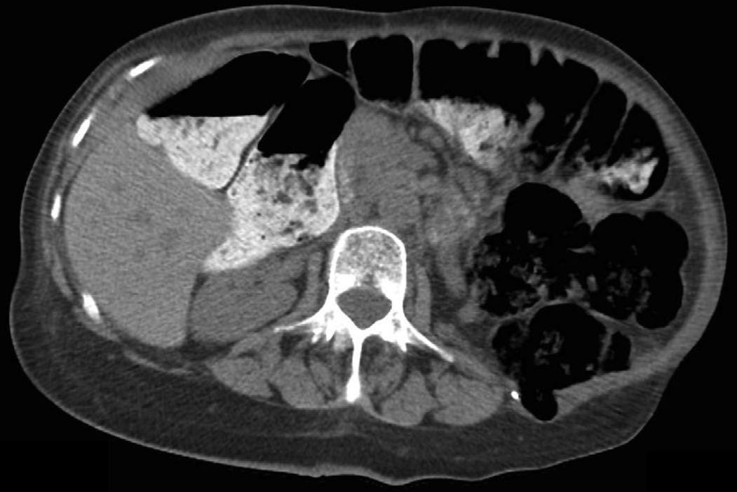 Computed tomography of a multiply recurrent left flank incisional hernia in a patient with previous left nephrectomy