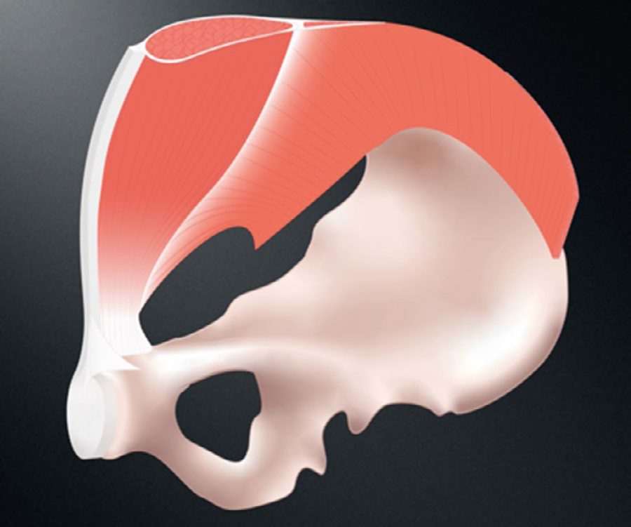 Posterior view of the right hemipelvis and associated abdominal musculature, the anatomical basis of the myopectineal orifice
