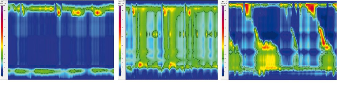 Achalasia types according to the Chicago classification on high-resolution manometry
