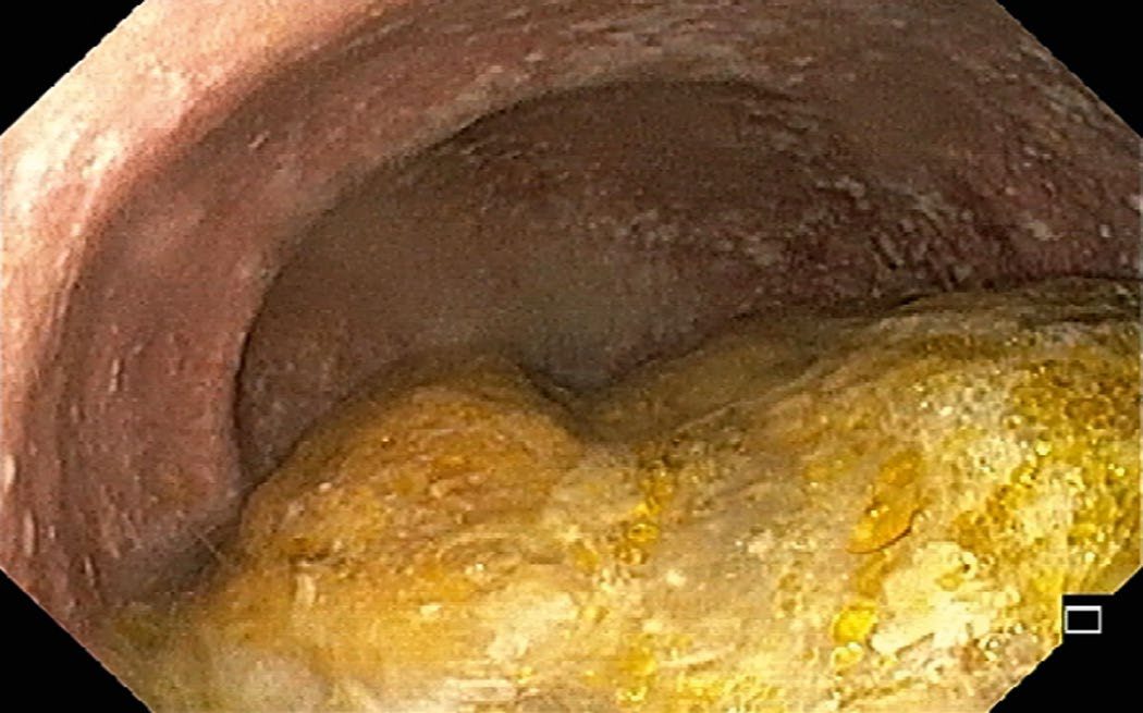 Endoscopy in a case of achalasia showing food residues in the oesophagus