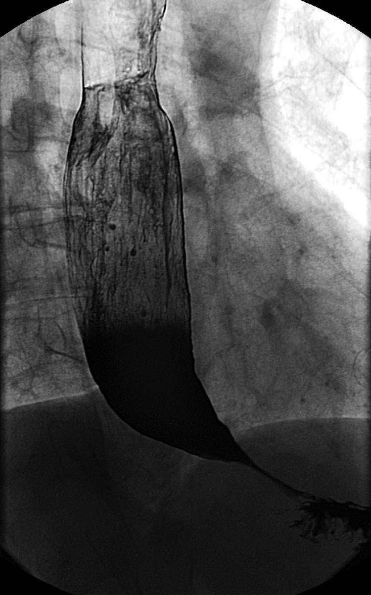 Barium swallow findings in a case of achalasia: distal esophageal narrowing, an air-fluid level, slow emptying of contrast into the stomach, and tertiary contractions