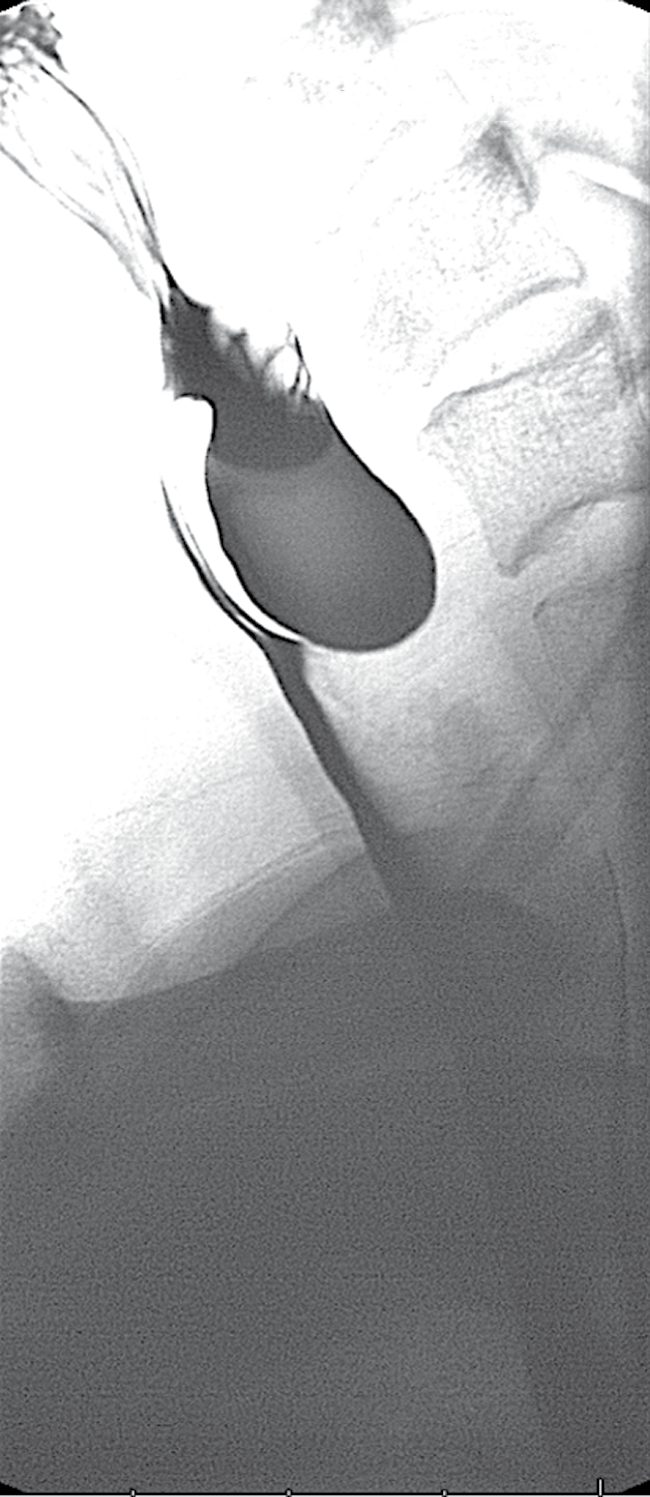 Lateral contrast study of a Zenker's diverticulum arising above the cricopharyngeus
