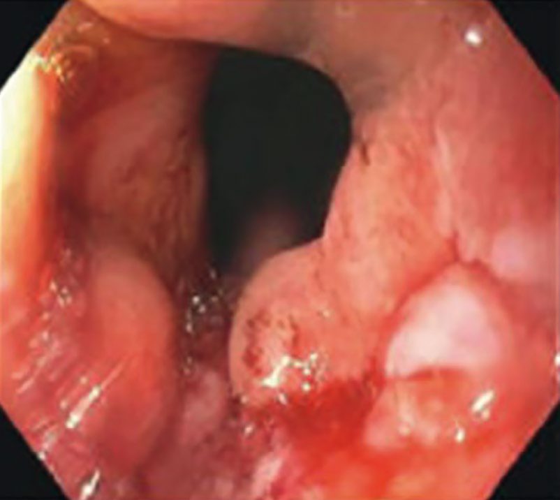 Endoscopic view of a partially obstructing esophageal tumour at the gastroesophageal junction