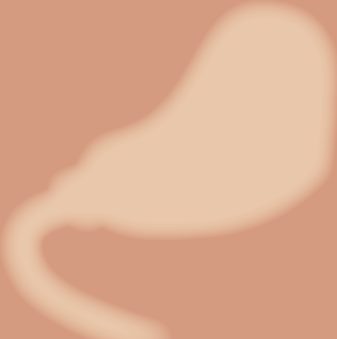 Double-tract reconstruction after proximal gastrectomy, with oesophagojejunostomy, gastrojejunostomy and jejunojejunostomy
