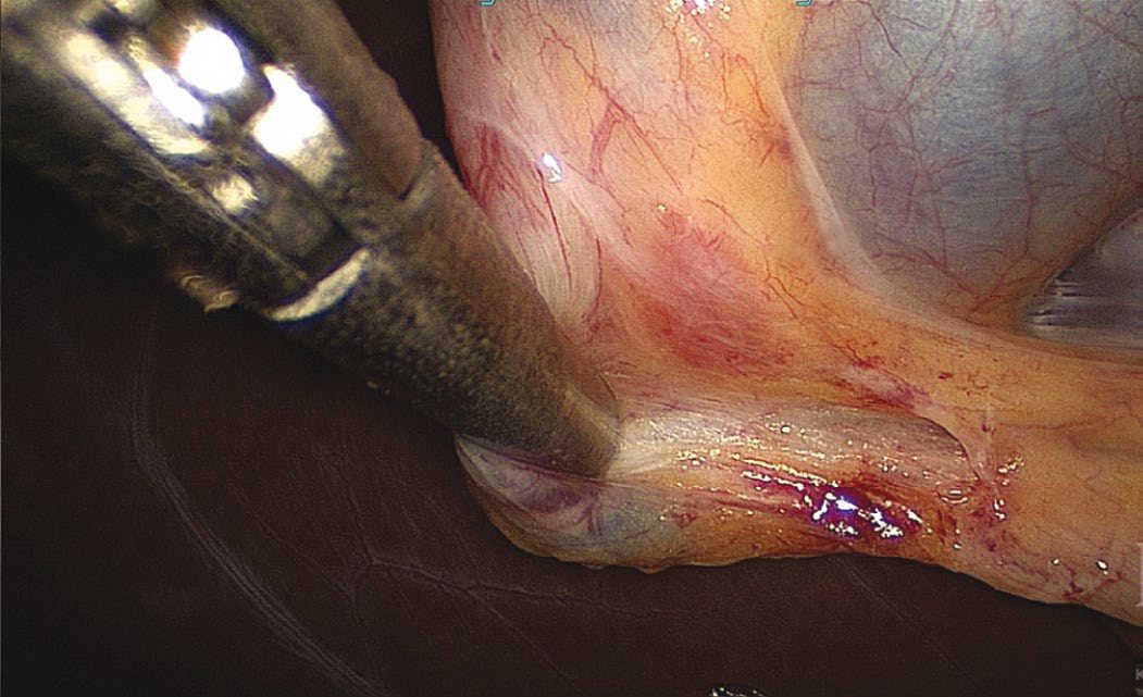 Operative photograph of Calot's node, useful for identifying the usual location of the cystic artery