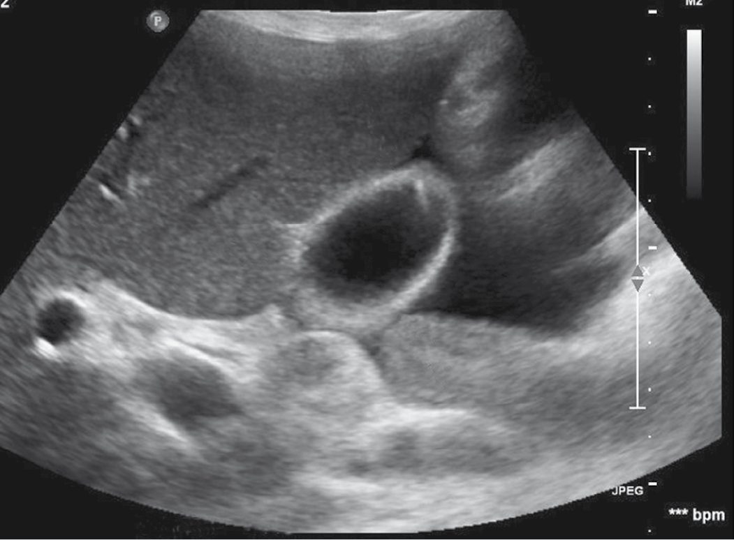 Ultrasound image of acute cholecystitis showing a thickened gallbladder wall