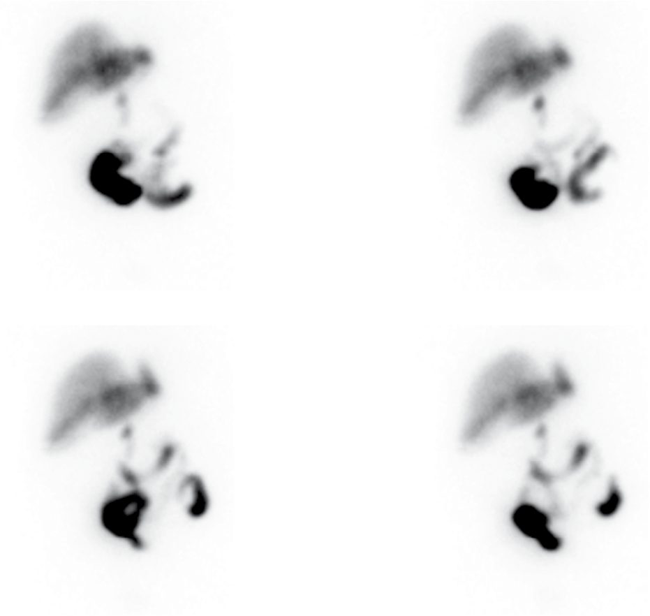 HIDA scan showing non-filling of the gallbladder, the scintigraphic hallmark of acute cholecystitis