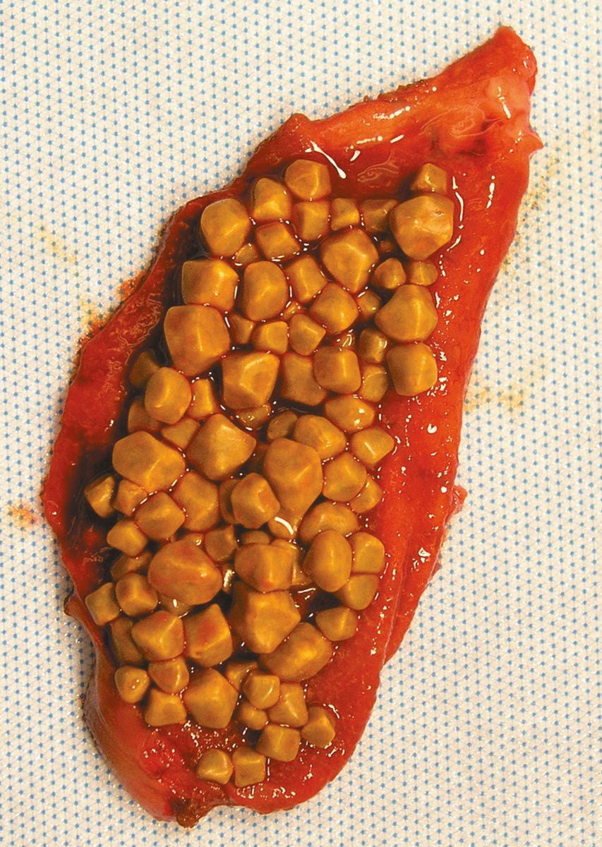Opened gallbladder packed with characteristic yellow cholesterol stones