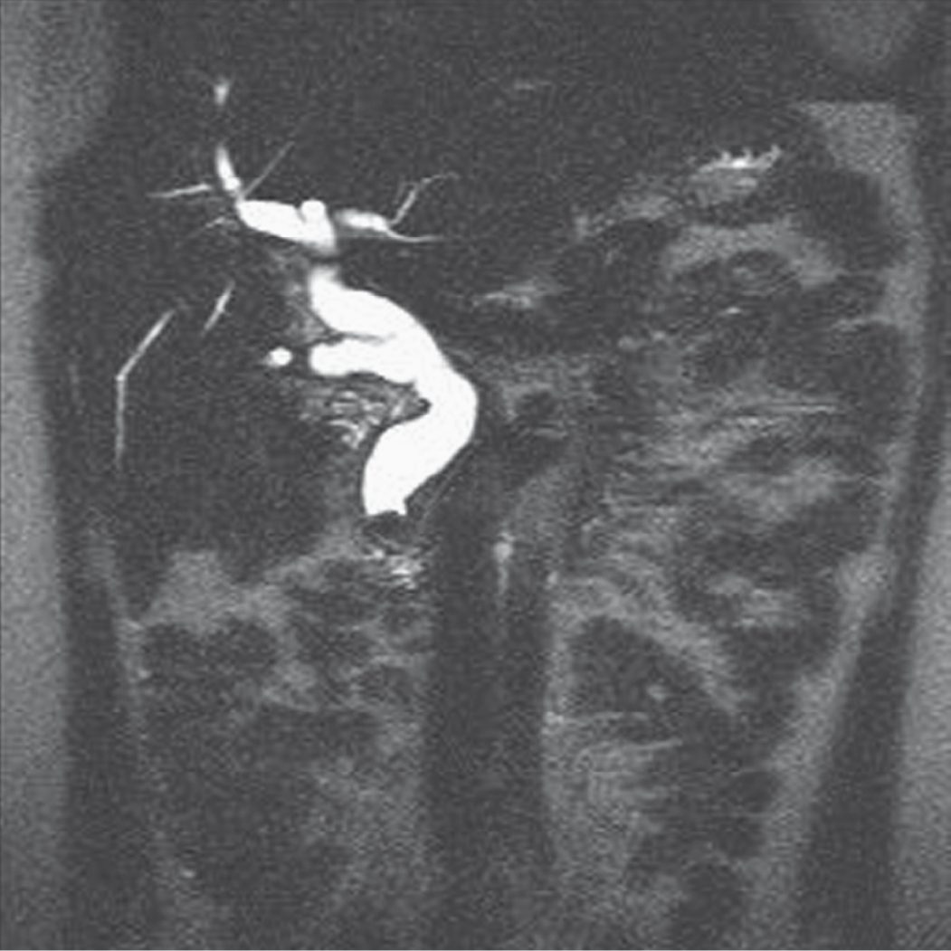 Magnetic resonance cholangiopancreatography showing choledocholithiasis: the dilated common bile duct ends abruptly with a convex intraluminal filling defect (arrow)