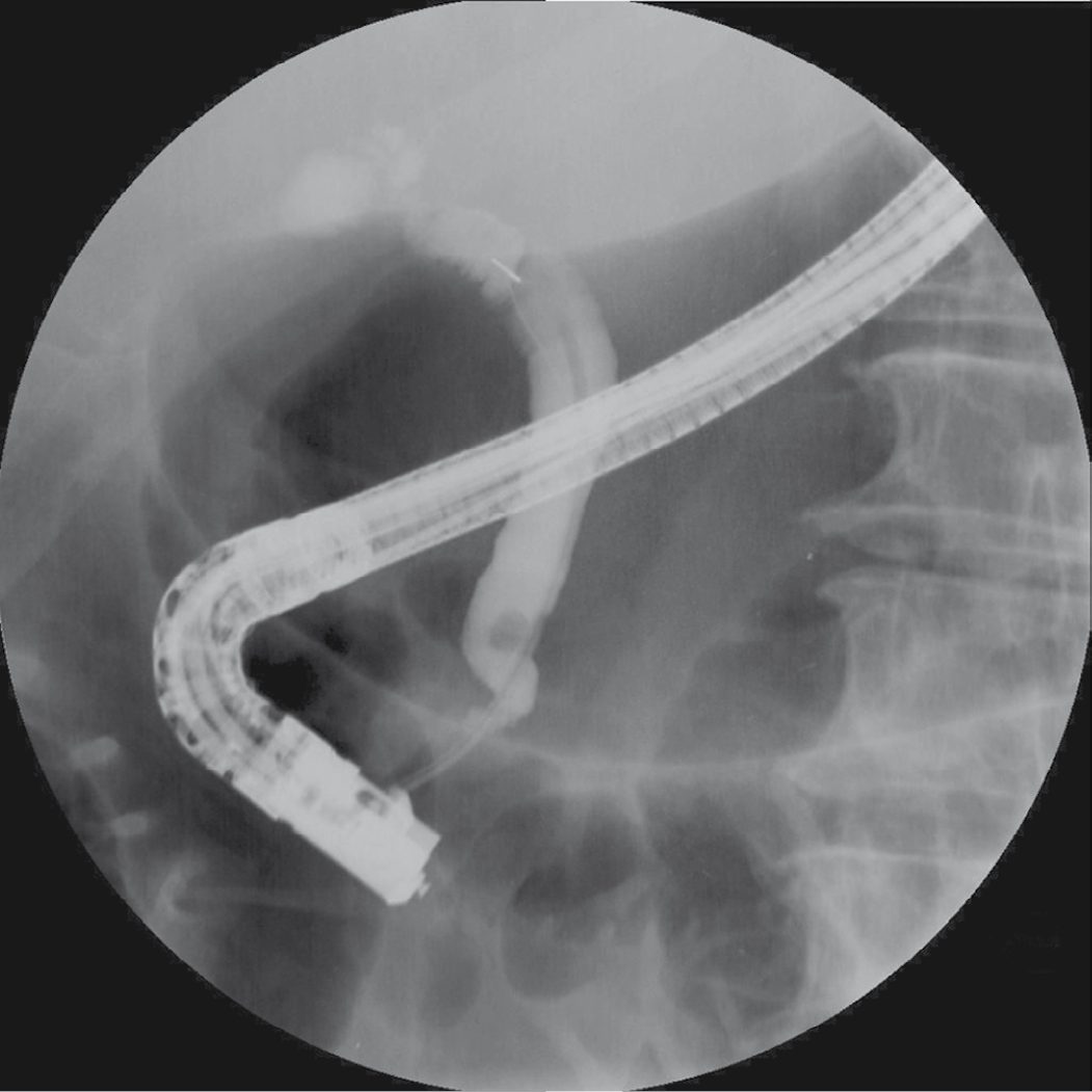 Endoscopic retrograde cholangiopancreatography showing choledocholithiasis: a filling defect is seen within the lumen of the common bile duct (arrow)