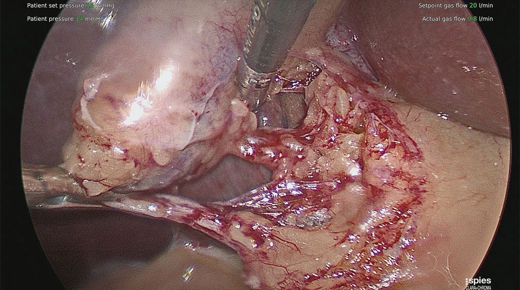Critical view of safety at laparoscopic cholecystectomy, with two structures seen entering the retracted gallbladder