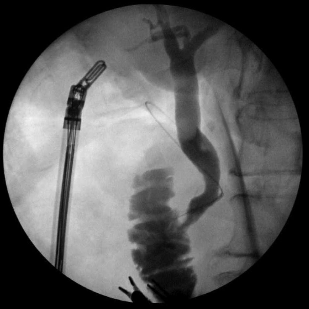 Intraoperative cholangiogram after retrieval of a stone by common bile duct exploration