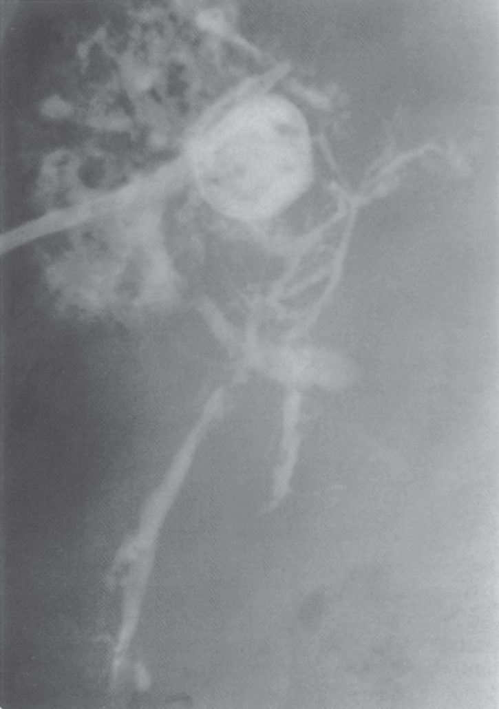Contrast study through a percutaneous drainage catheter in a hepatic abscess, showing the typical irregular loculated cavity and communication with the biliary tree