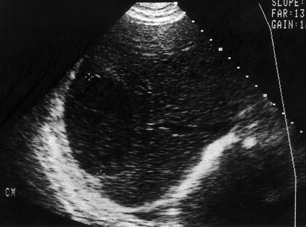 Typical ultrasound appearance of an amoebic hepatic abscess
