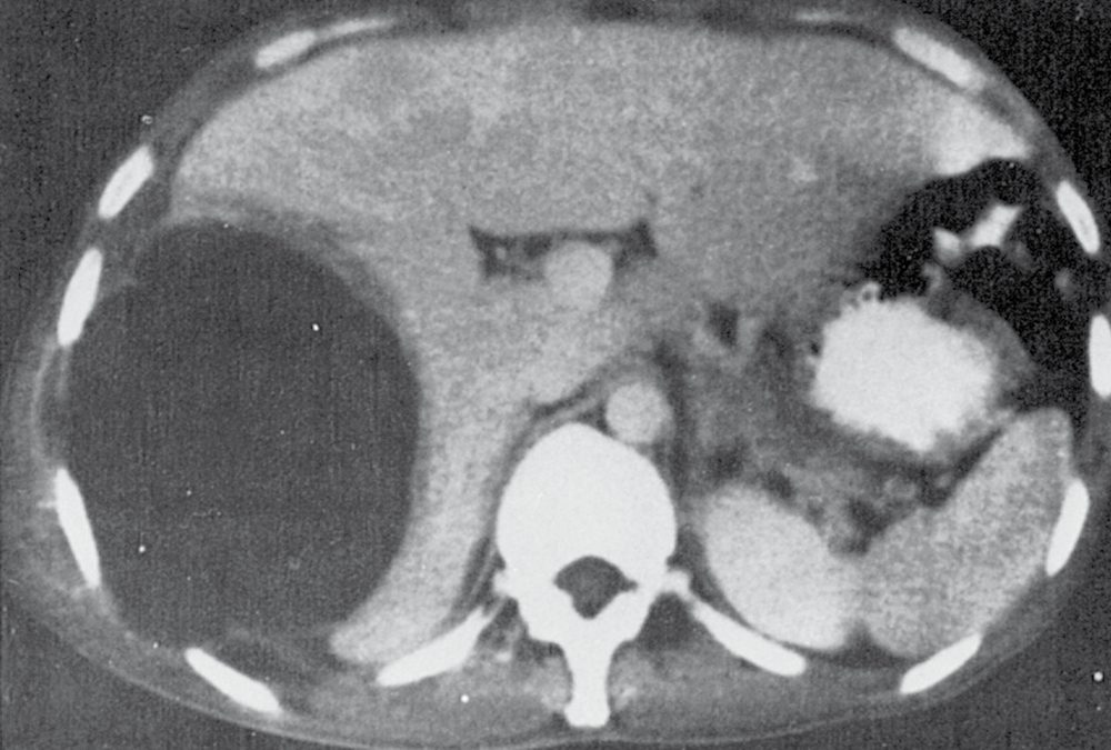 Computed tomography of an amoebic liver abscess: the lesion is peripherally located and round, with a non-enhancing rim showing peripheral oedema
