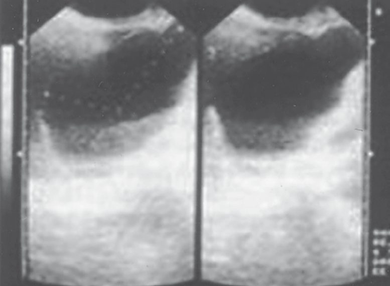 Ultrasound appearances of a hydatid cyst at varying stages