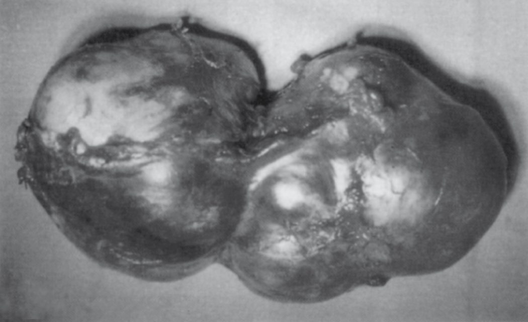 Intact specimen after pericystectomy for a peripheral hydatid cyst of the left liver; the entire pericyst has been removed