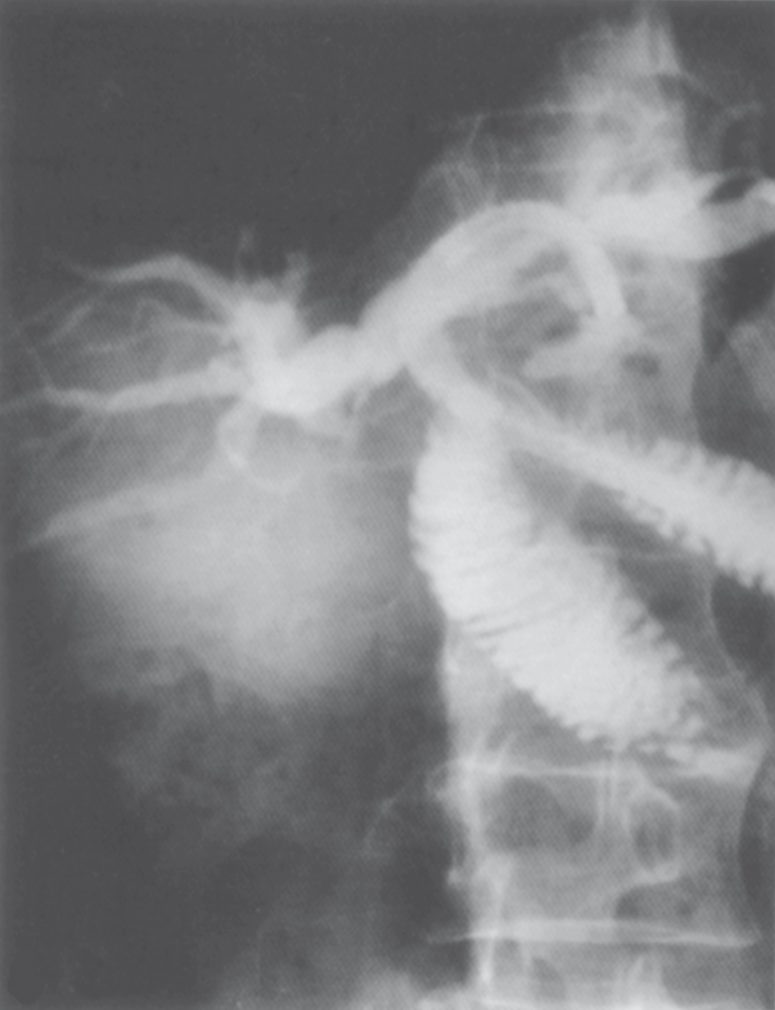 Hepaticojejunostomy to the segment III duct for recurrent pyogenic cholangitis, with a choledochoscope passed through the anastomosis after complete stone clearance