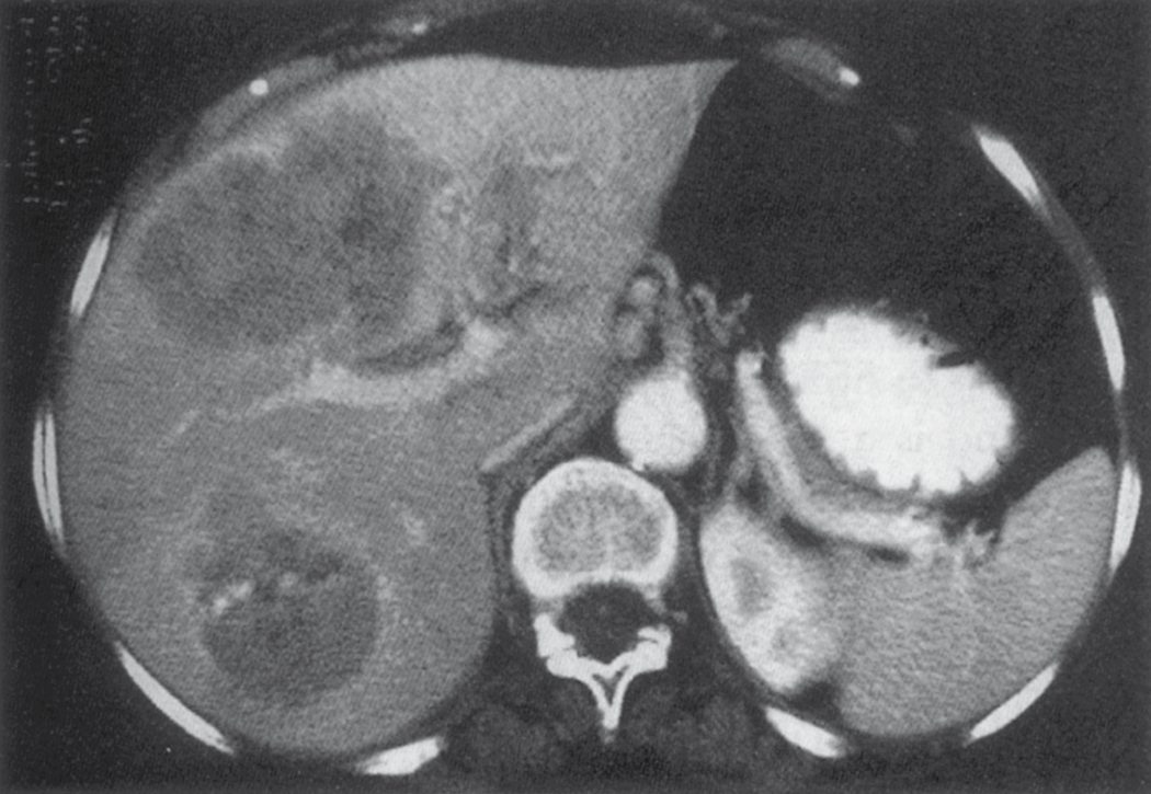 Contrast-enhanced computed tomography showing multifocal hepatocellular carcinoma; the left portal vein is invaded and expanded by tumour (arrows)