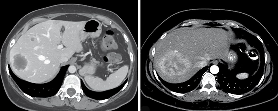 Contrast-enhanced CT showing (A) hypovascular colorectal liver metastases on portal venous phase and (B) hypervascular neuroendocrine liver metastases on arterial phase