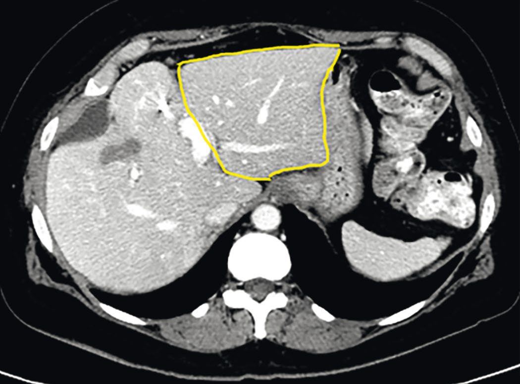 The volume of the future liver remnant (outlined in yellow) measured on CT with volumetric software before planned resection or portal vein embolization