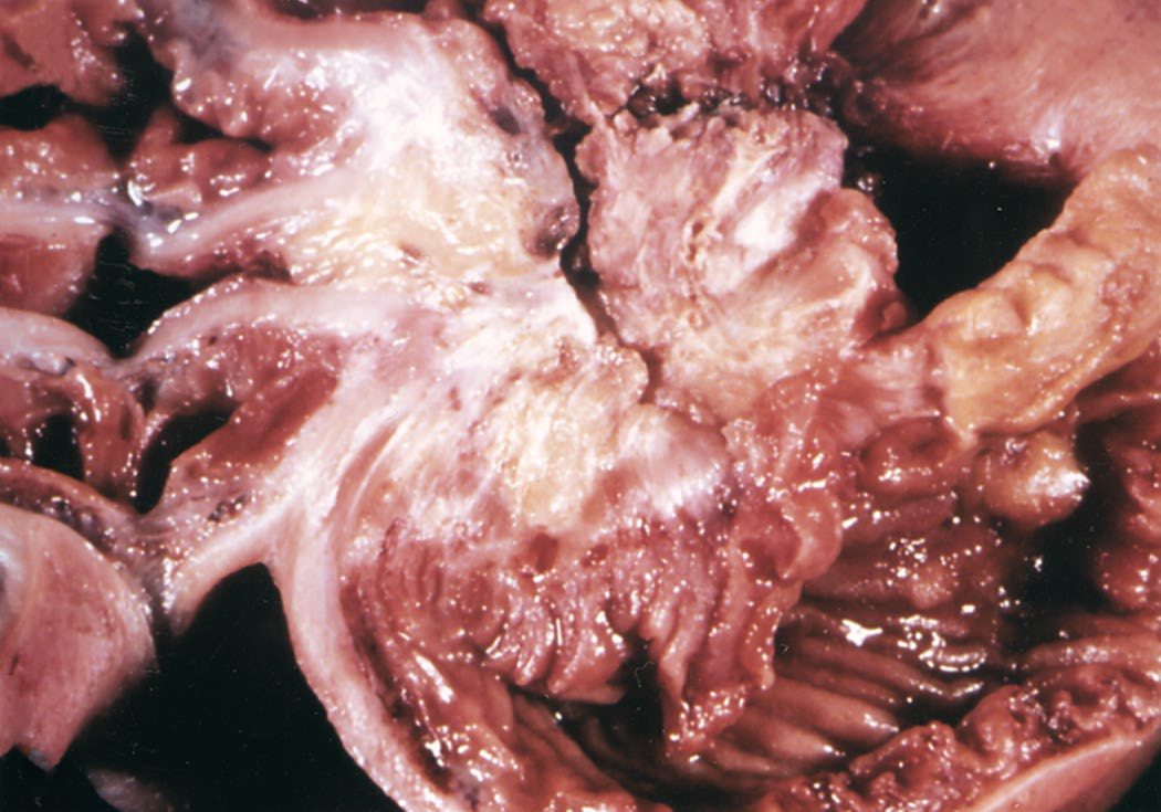 Gross appearance of a neuroendocrine tumour of the distal ileum, showing the intense desmoplastic reaction and fibrosis of the bowel wall