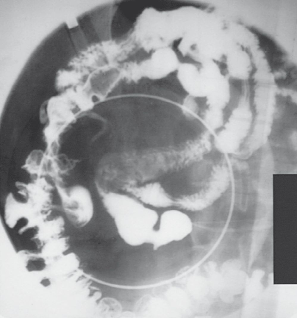 Multiple large jejunal diverticula lying in the mesentery of an older patient