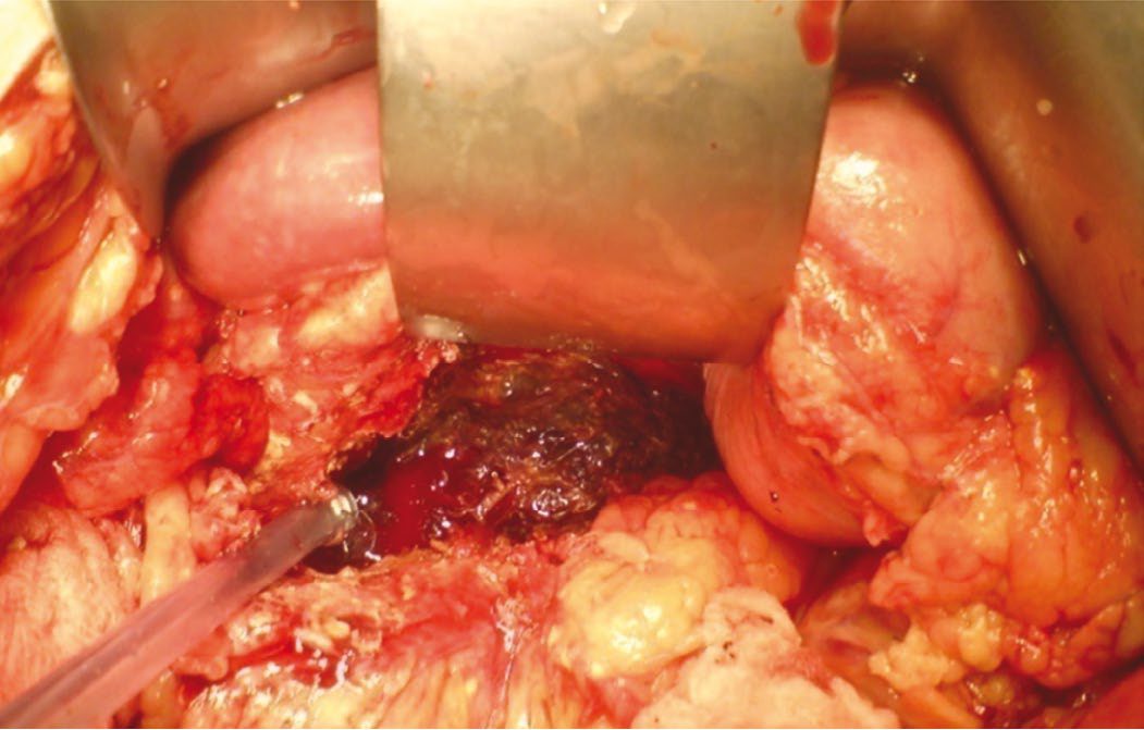 Infected pancreatic necrosis following severe alcohol-induced pancreatitis