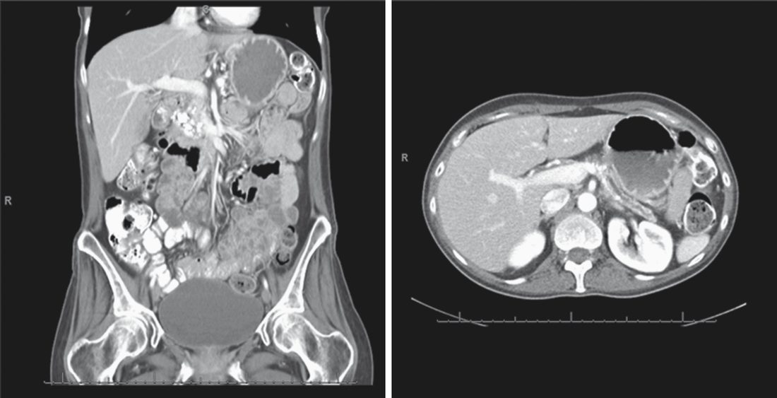 Typical CT findings in chronic pancreatitis: pancreatic duct dilation (long arrow) and intrapancreatic calcifications (short arrow)