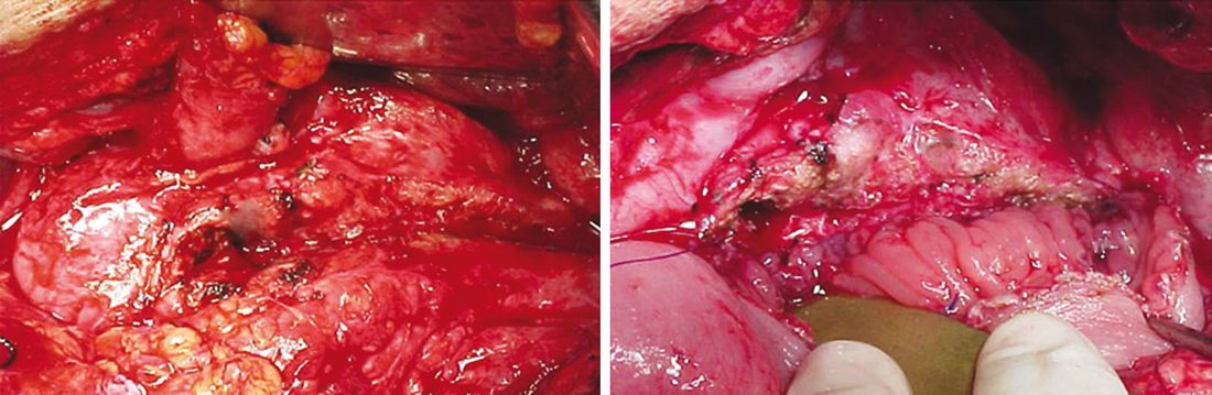 Frey procedure: (A) dilated main pancreatic duct in the head and body after the anterior surface of the pancreas is opened; (B) side-to-side pancreaticojejunal anastomosis