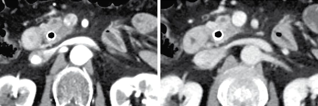 Resectable pancreatic adenocarcinoma: CT in the late-arterial and portal-venous phases shows a low-attenuation mass confined to the pancreas with no contact with the superior mesenteric vessels