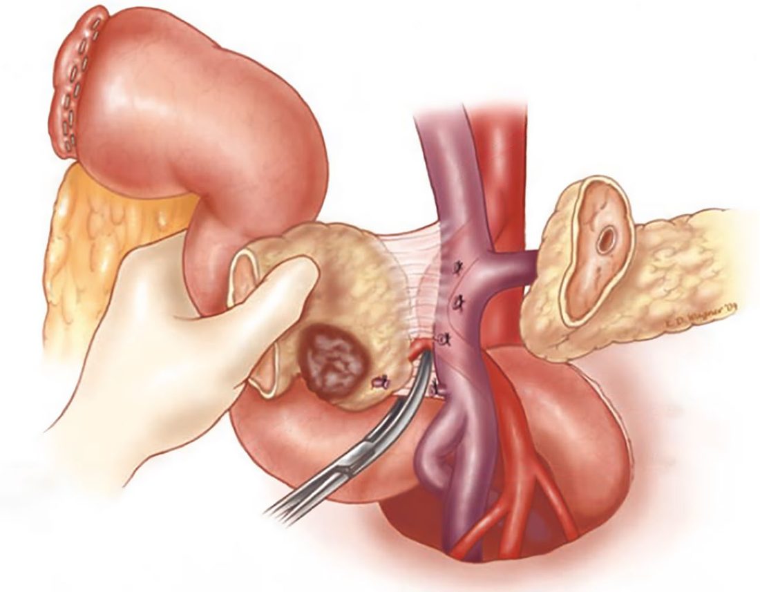 Division of the neck of the pancreas and separation of the head of the pancreas from the superior mesenteric vein and superior mesenteric artery