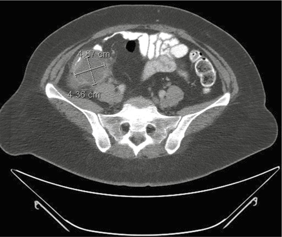 Contrast CT of complicated appendicitis showing a measured periappendiceal abscess cavity in the right lower quadrant