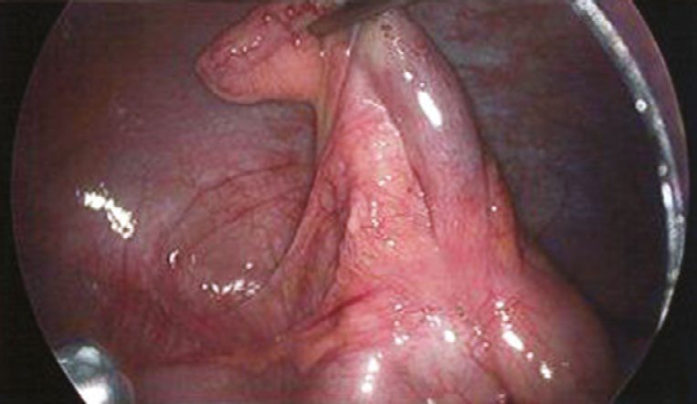 Laparoscopic appendicectomy: visualisation and upward retraction of the appendix, then division of the mesoappendix and base