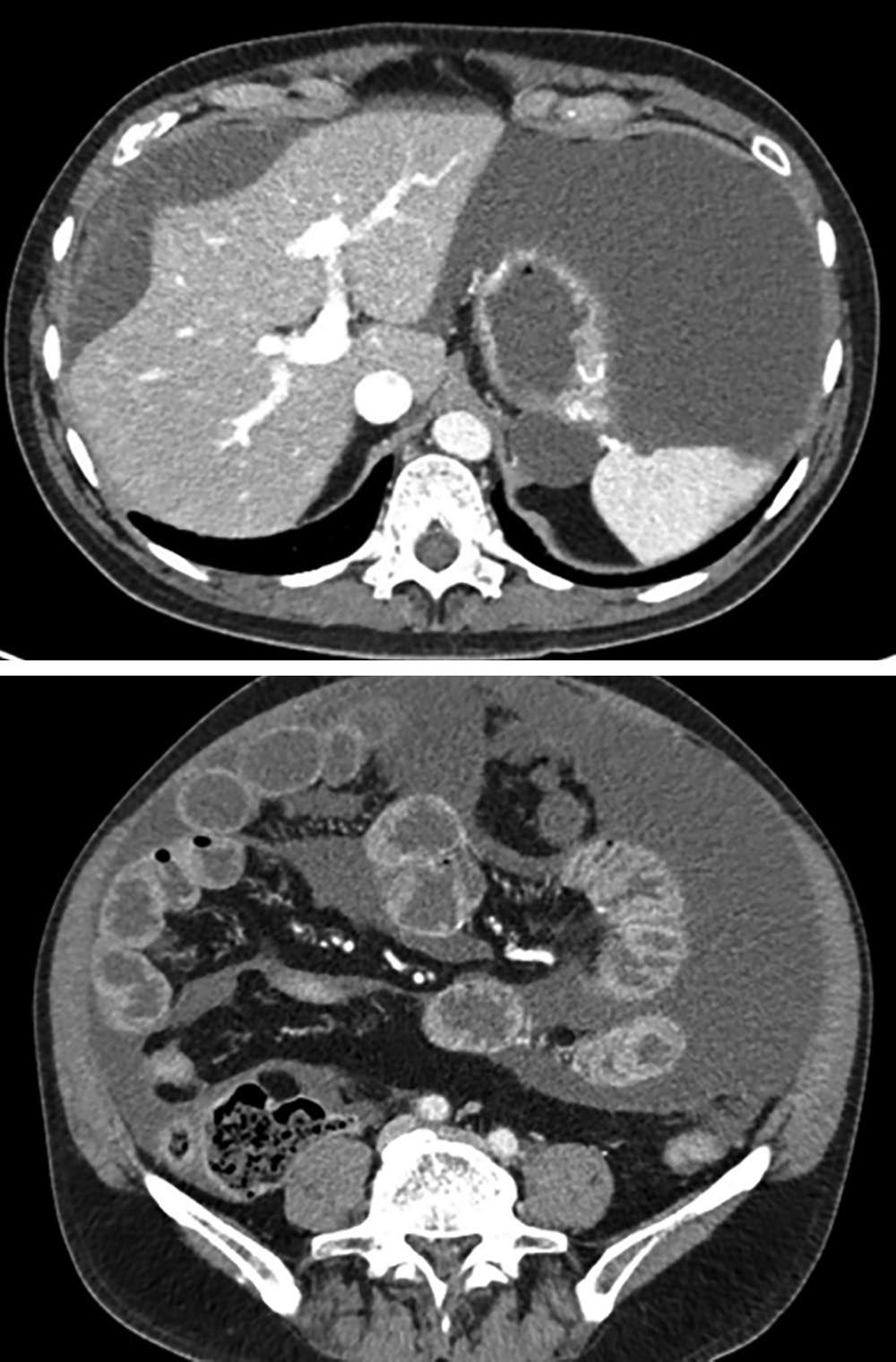 CT of the abdomen showing mucinous ascites and disseminated peritoneal disease