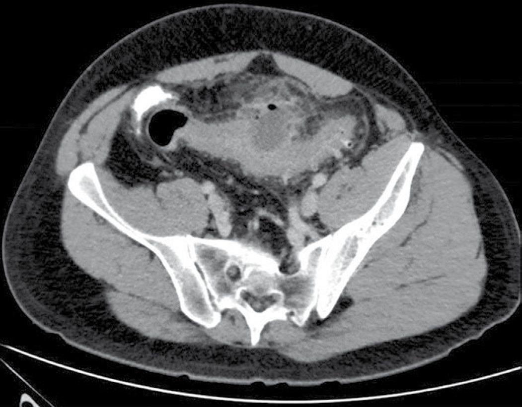 CT of the pelvis showing sigmoid diverticulitis with a thickened bowel wall, fat stranding and a pericolonic abscess (arrow), modified Hinchey grade 1b