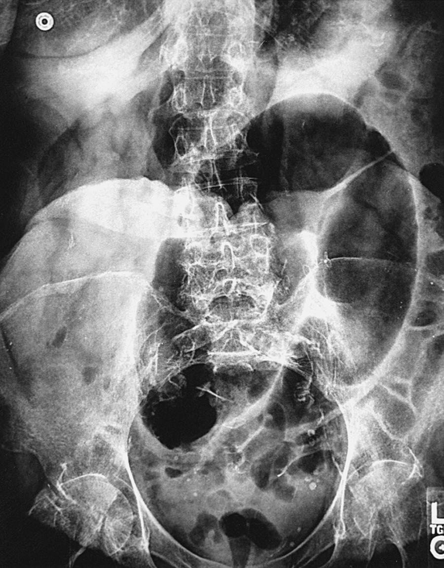 Plain film of sigmoid volvulus showing the classic bent inner-tube appearance