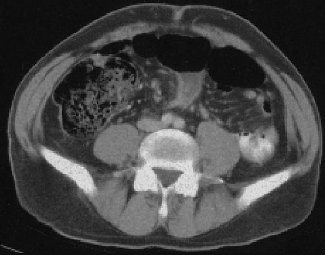 CT of the abdomen in sigmoid volvulus, showing the characteristic whorl of twisted mesentery