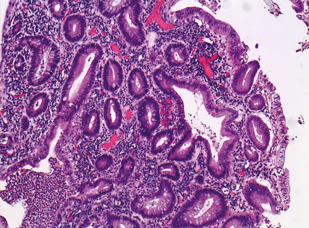 Histological section of active ulcerative colitis: glandular architectural distortion with irregular branching, an expanded lamina propria and a crypt abscess