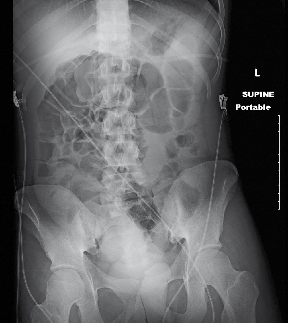 Toxic megacolon: supine abdominal film showing marked distension of the transverse colon in a young man with fulminant colitis